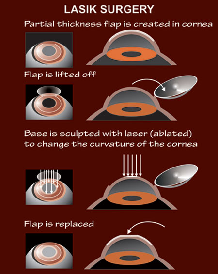 Kadam Eye Lasik Centre Lasik Surgery With Flap Creation